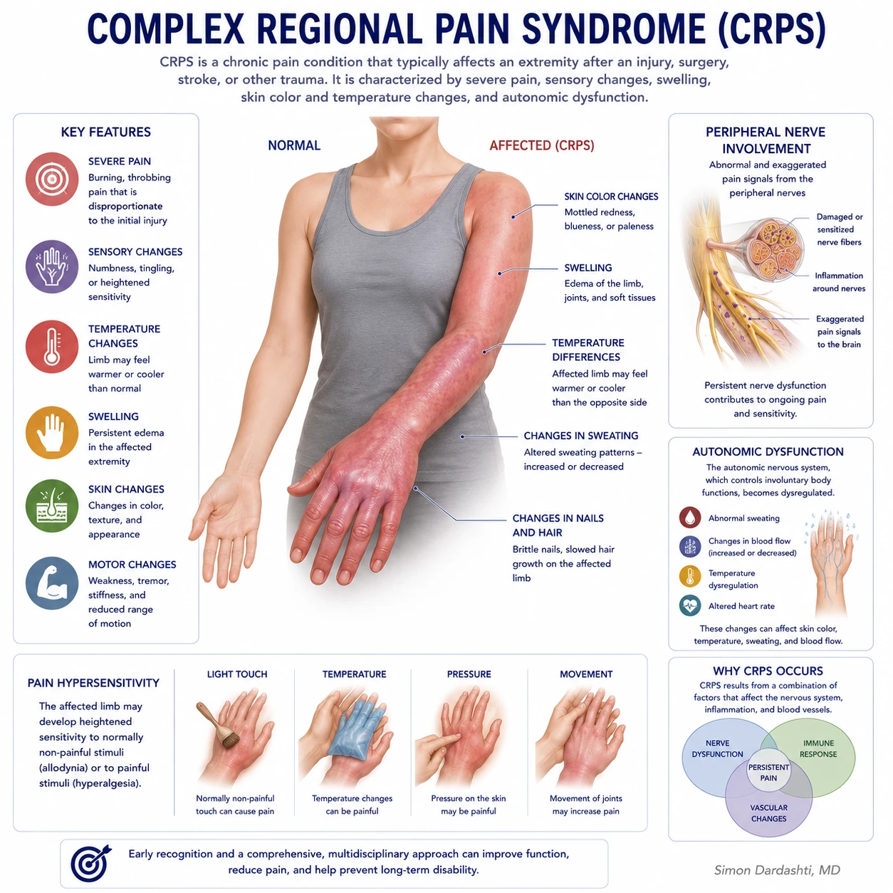 CRPS pathophysiology infographic showing pain signaling, inflammation, autonomic changes, and functional symptoms.